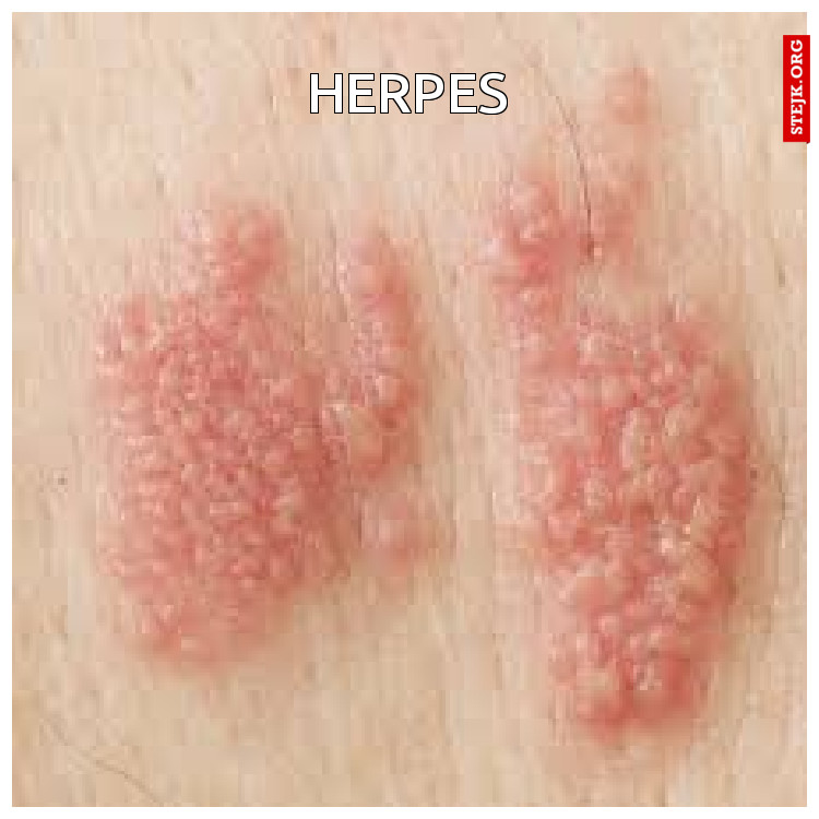 herpes