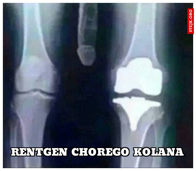 rentgen chorego kolana