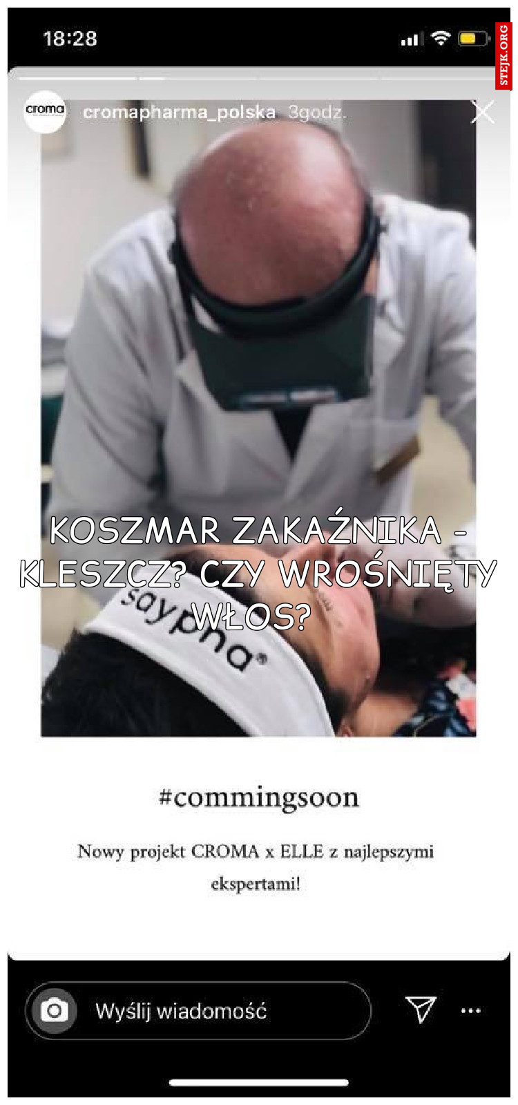 Koszmar zakaźnika - kleszcz? Czy wrośnięty włos? 